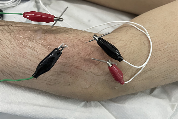 Electroneuroacupuntura